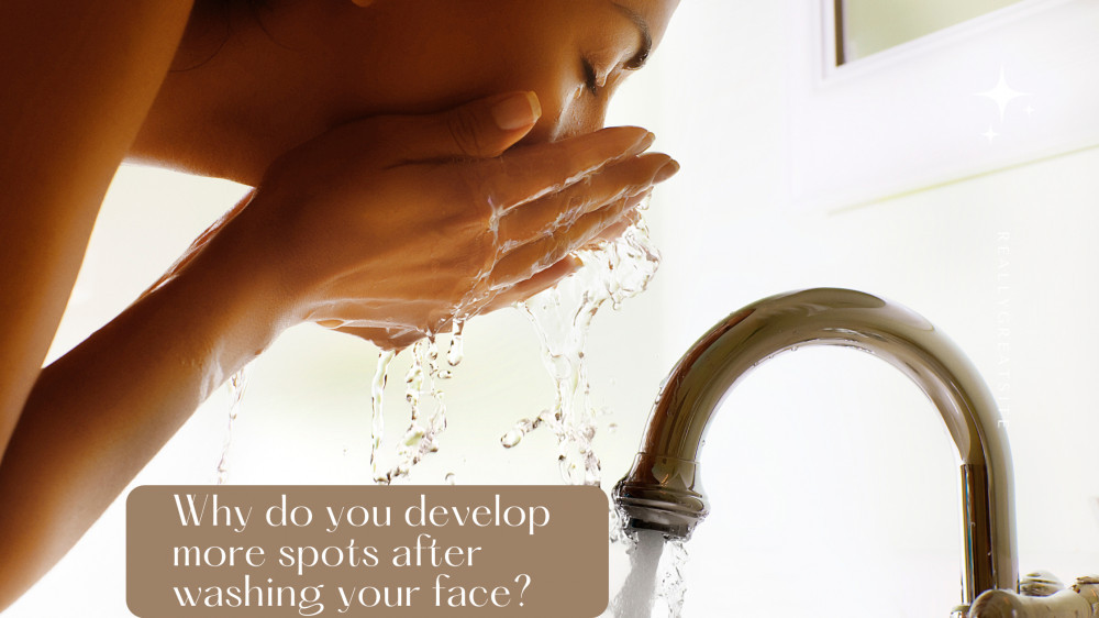 here-s-why-you-develop-more-spots-after-washing-your-face-all-about