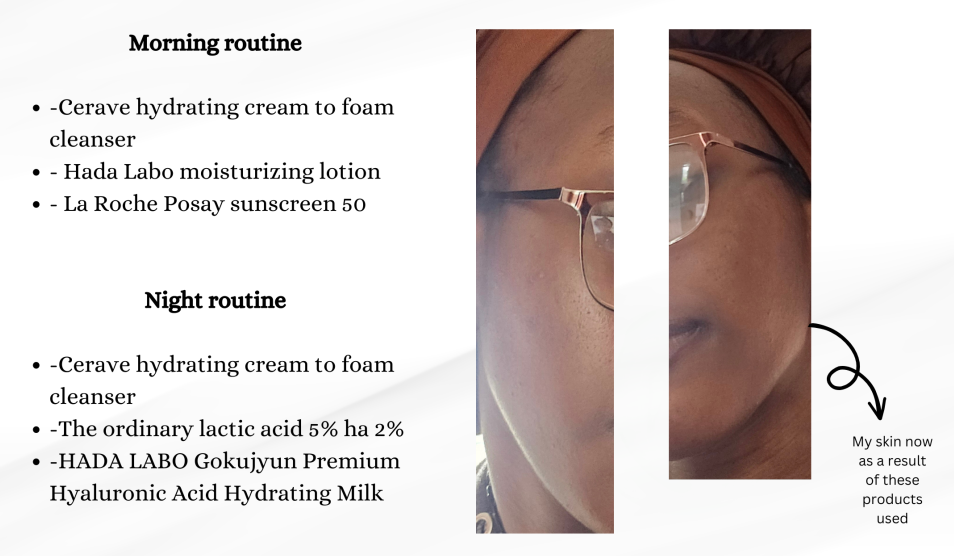 How A Simple 3-Step Skincare Routine Cleared My Acne | Web Skincare ...