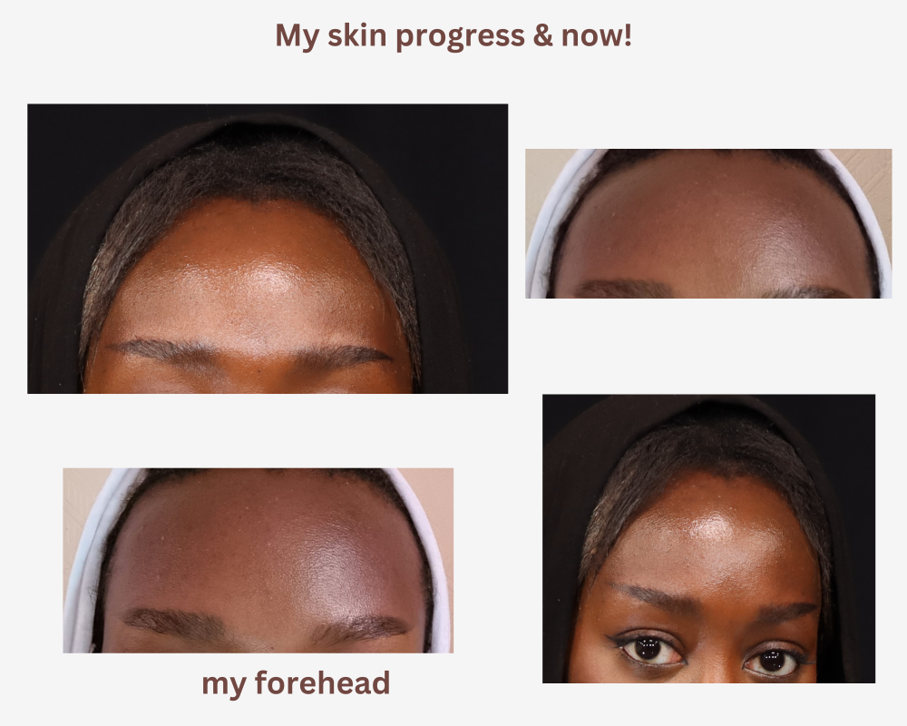 How A Simple 3-Step Skincare Routine Cleared My Acne | Web Skincare ...