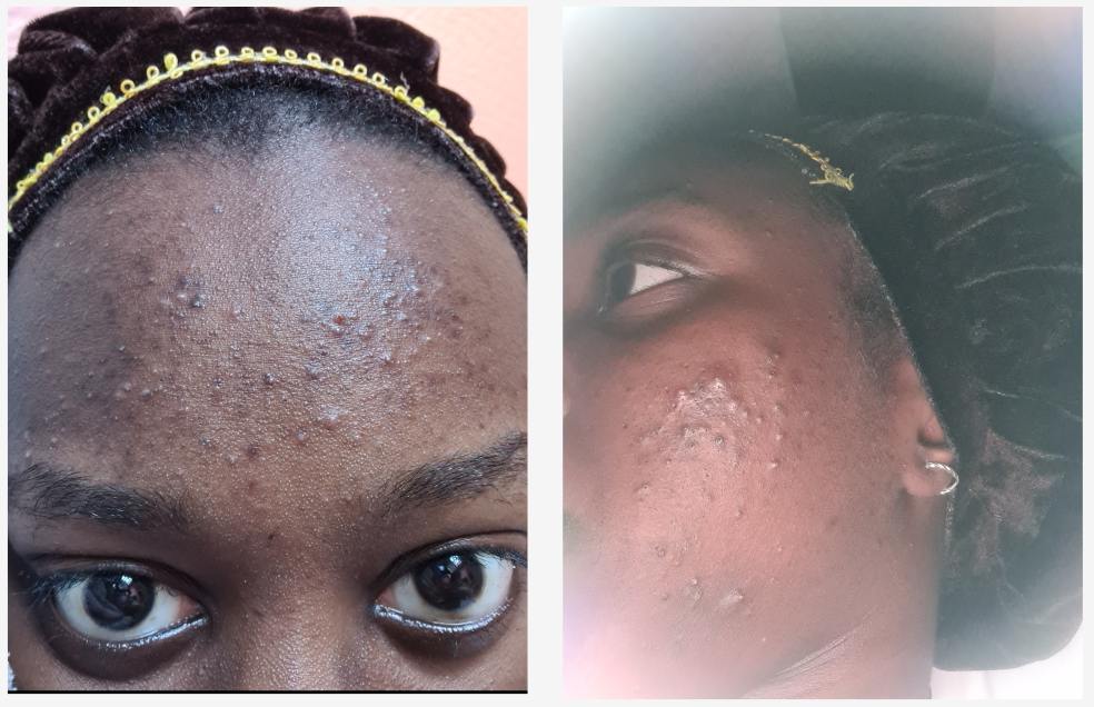 How A Simple 3-Step Skincare Routine Cleared My Acne | Web Skincare ...