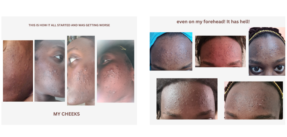 The Importance Of Self-Care When Dealing With Acne | Web Skincare Solution - Dealing With Acne Prevention Frustrations