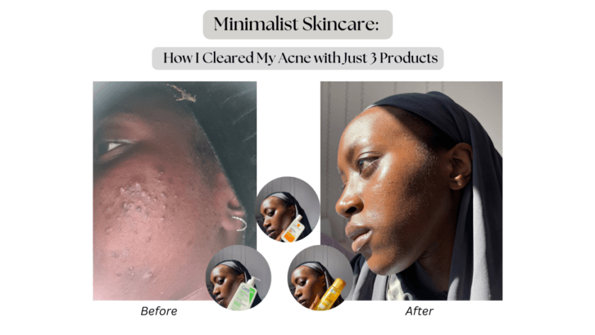 Minimalist Skincare: How I Cleared My Acne With Just 3 Products | Web ...