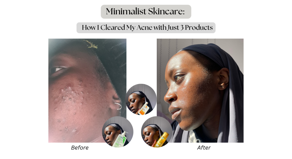 Minimalist Skincare: How I Cleared My Acne With Just 3 Products | Web ...
